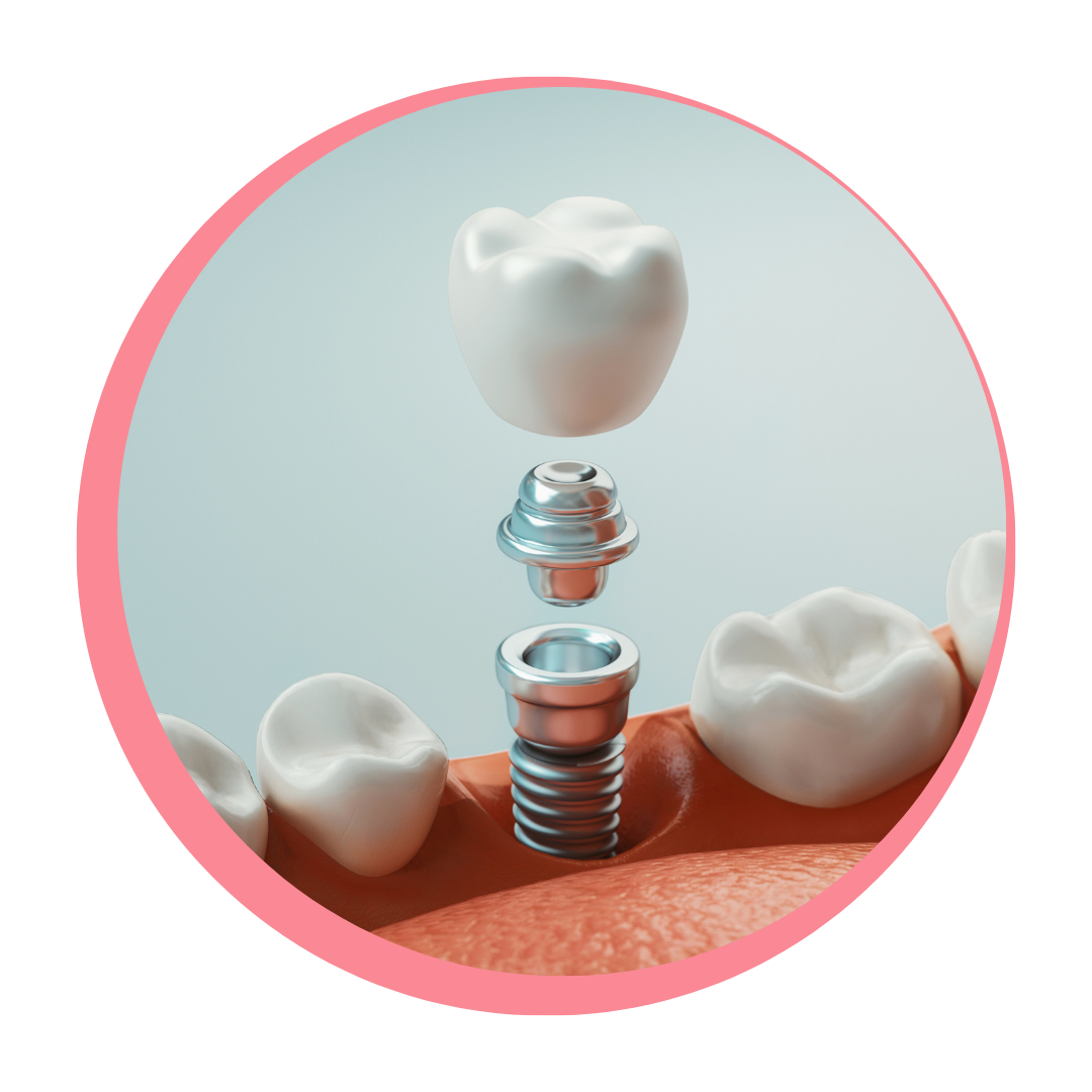 Here’s how full arch dental implants could transform your smile